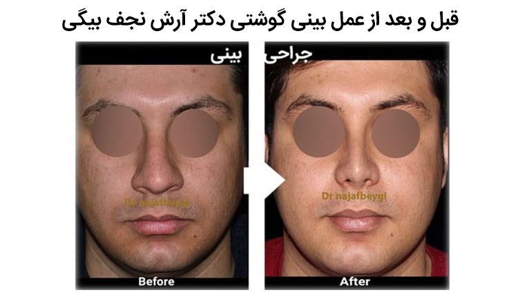 قبل و بعد از جراحی بینی توسط دکتر.  آرش نجف بیگی