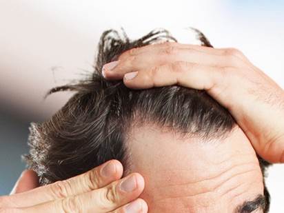 علل ریزش مو در مردان و زنان