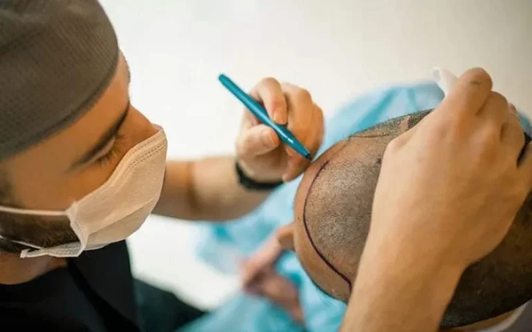 چه چیزهایی بعد از کاشت مو ضرر دارد؟