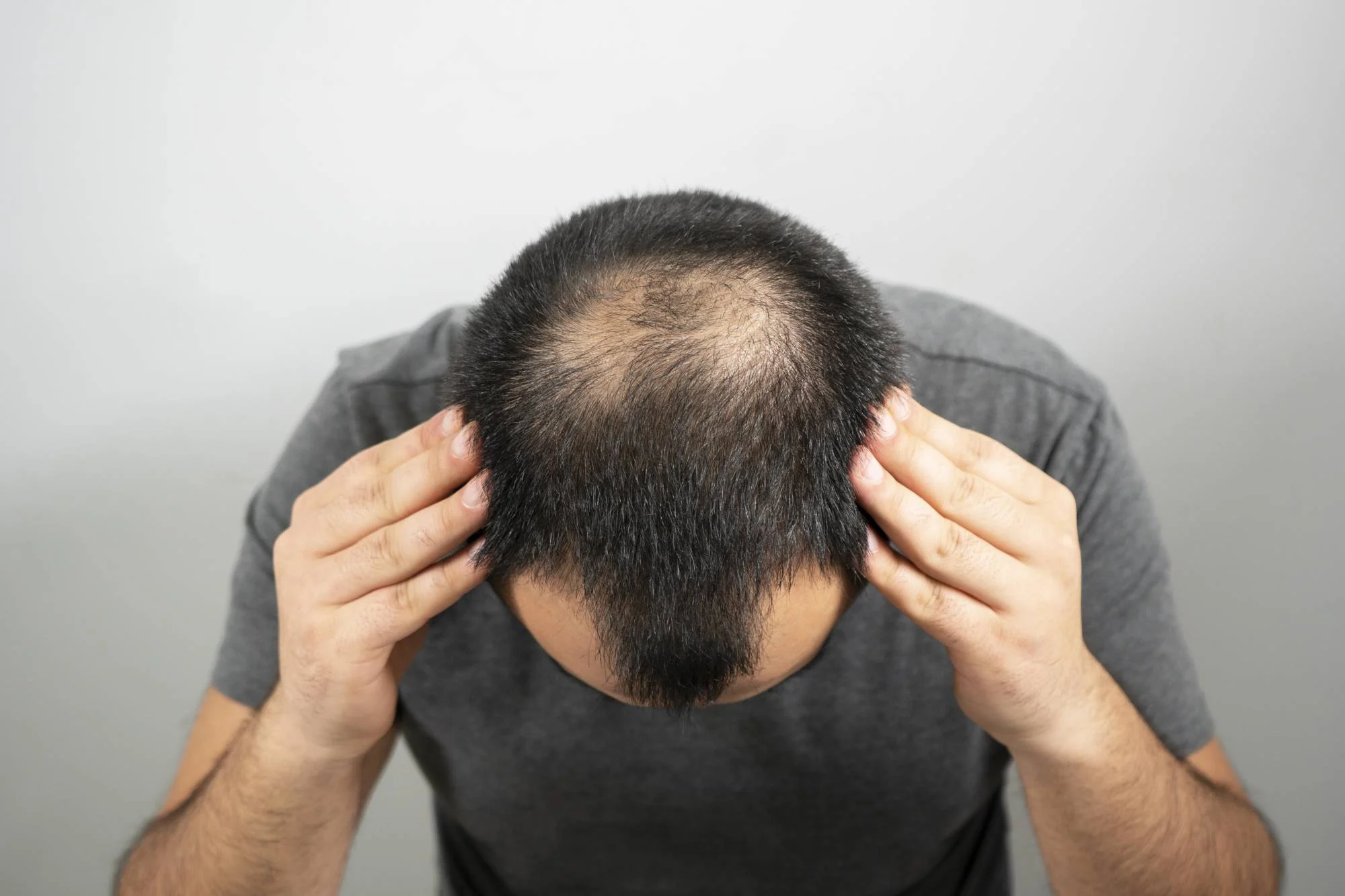 Die beste behandeling vir haarverlies by mans