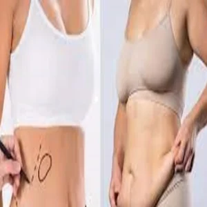 What-is-Lipo-Abdo