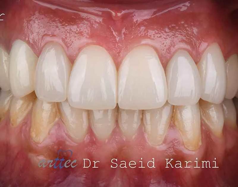 The importance of tooth restoration