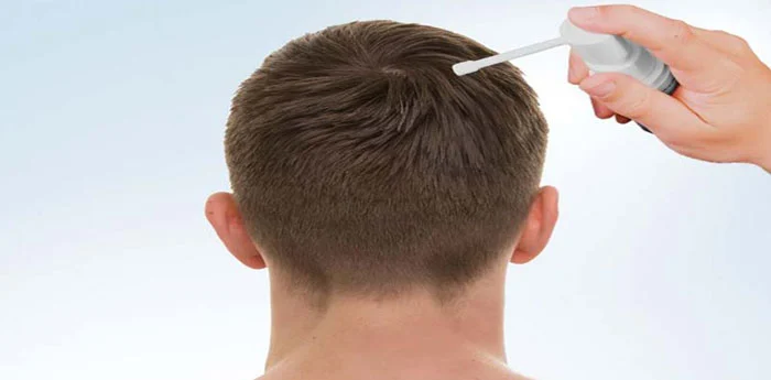 What is minoxidil and how does it affect hair loss?